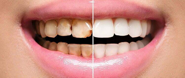 The Treatment Under Dental Bonding