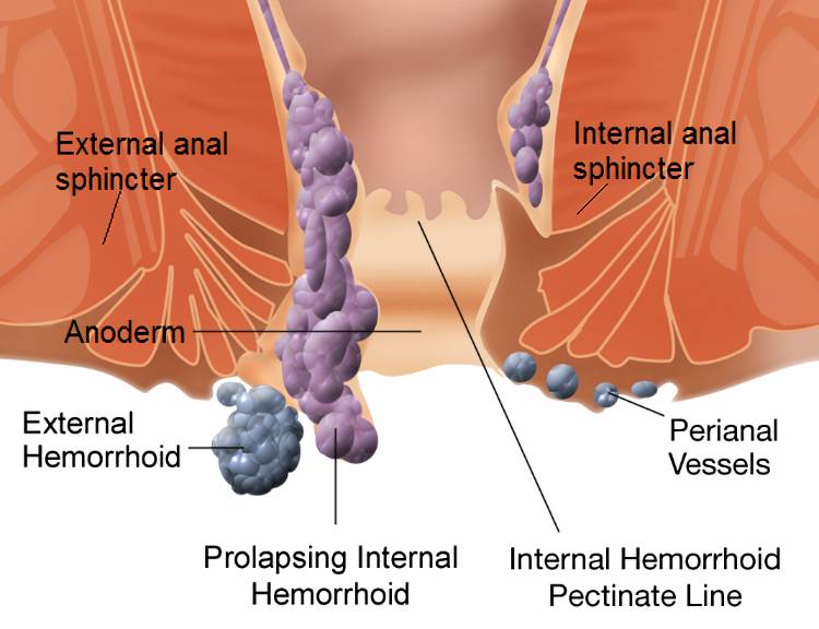 What Is Hemorrhoid?